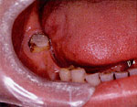 歯の欠損を長期間放置しておいたため歯が移動してしまいました