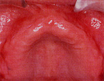 術前の口腔内：義歯の安定が悪い