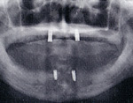 インプラント埋入手術後のレントゲン写真