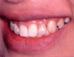義歯の内面にも金具を取り付け、インプラントに「カチャ」とはめ込み、義歯が安定する