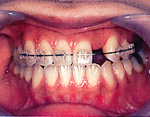 矯正で歯を正しい位置に戻し 欠損した歯のスペースを取り戻します