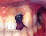 インプラントを埋入し、骨に固定するのを待つ間に歯茎の粘膜も自然に誘導されます