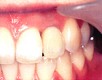 人工歯を装着して完成 歯茎のラインもきれいになっています