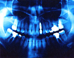 歯の欠損を長期間放置しておいたため歯が移動してしまいました