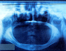 無歯顎のレントゲン写真