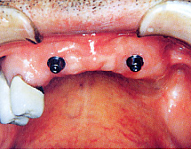 上顎の歯が多数欠損しているため、インプラントを2本埋入