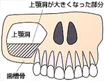 上顎の内部には上顎洞という空洞があります 歯槽骨が吸収してしまうと、インプラント埋入ができない