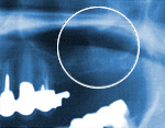 上顎洞のレントゲン写真