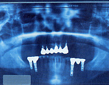 上顎の奥歯が欠損して、部分入れ歯を使用